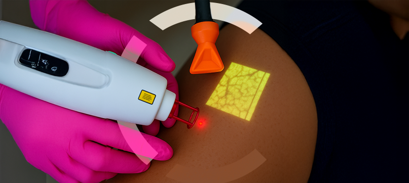 Imagem interna tratamento de vasinhos da face Clariana Casali