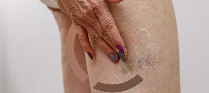 Imagem interna tratamento de vasinhos da face Clariana Casali