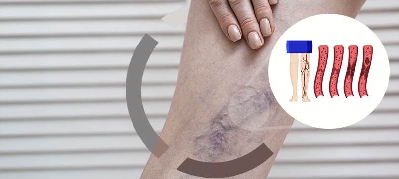 Imagem interna tratamento de vasinhos da face Clariana Casali